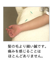 髪の毛より細い鍼です。痛みを感じることは殆どありません