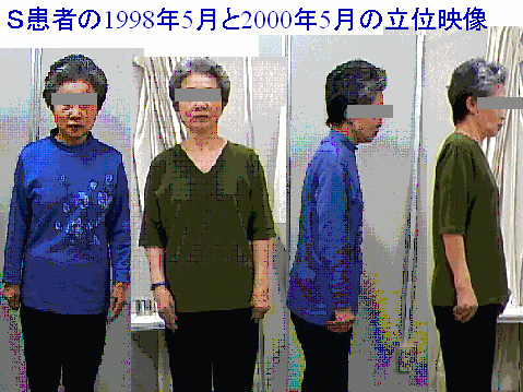 S患者の1998年5月と2000年5月の立位映像